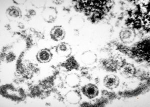 F,65y. | Epstein-Barr or cytomegaly virus - hairy leukoplakia - tongue